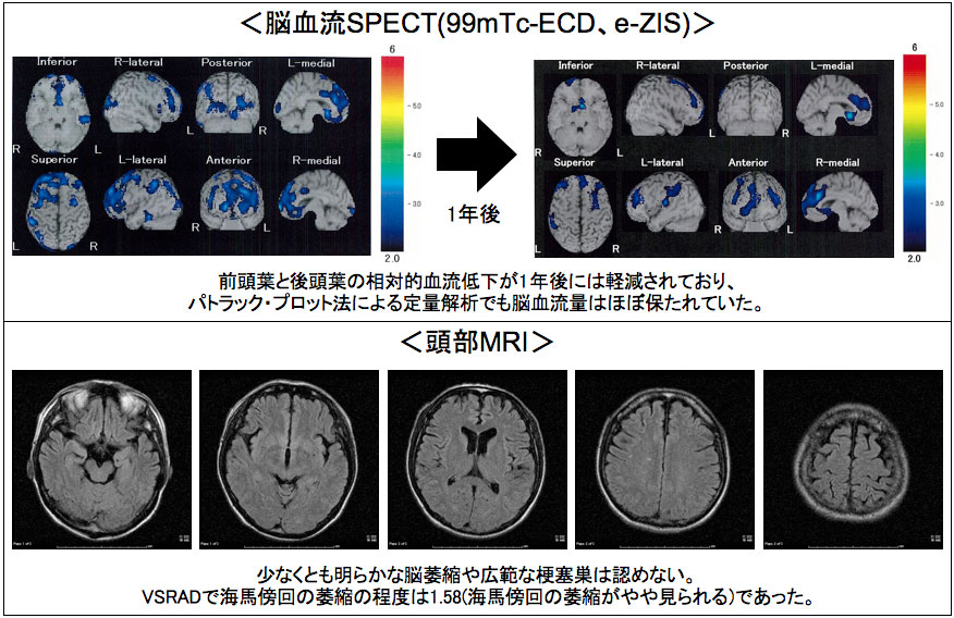 ]SPECT(99mTc-ECDAe-ZIS)Otƌ㓪t̑ΓIቺ1Nɂ͌yĂA
pgbNEvbg@ɂʉ͂ł]ʂ͂قڕۂĂB MRIȂƂ炩Ȕ]ޏkL͂ȍ[Ǒ͔F߂ȂBVSRADŊCnT̈ޏk̒x1.58(CnT̈ޏk〈)łB
 