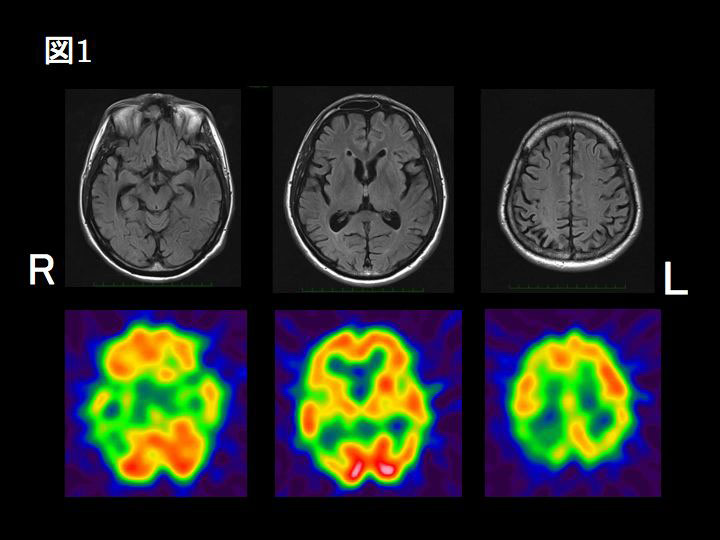 ǗAMRI FLAIR摜iijCIMP-SPECT摜iij 