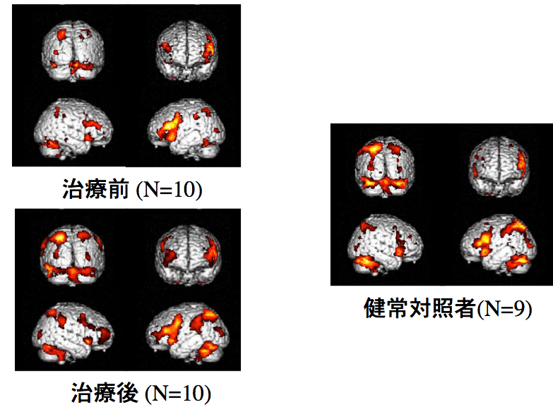 図2 治療前後のOCD患者群と健常対照群の画像比較
