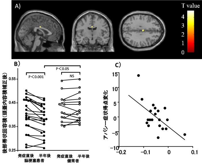 皮質下脳梗塞患者で、発症後半年間の間に、灰白質容積が有意に減少した領域