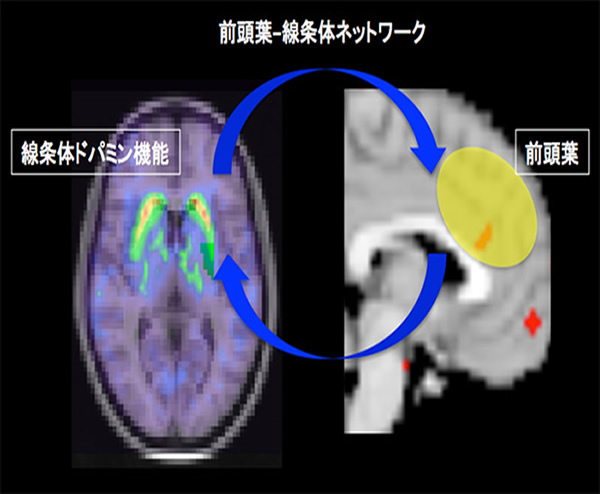 うつ病における脳内ネットワークの機能障害