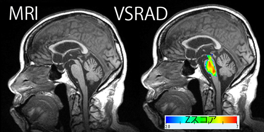 図4 進行性核上性麻痺でのVSRAD advance解析