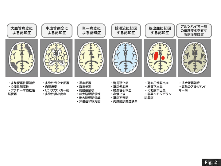 }2 ǐFmQivascular cognitive impairment: VCIj̗Տa^
1.匌ǕaςɂFmǁA2.ǕaςɂFmǁA3.PaςɂFmǁA4.󗬂ɋNFmǁA5.]oɋNFmǁA6.AcnC}[a̕aωL]ǏQ