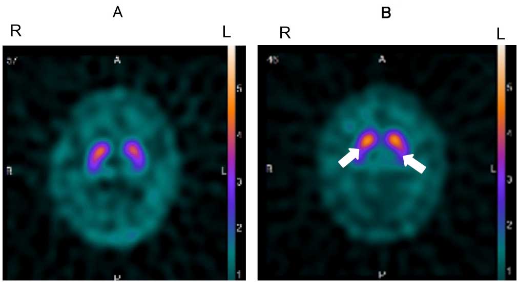 DaTSCAN(<sup>123</sup>I-ioflupane SPECT)